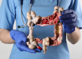 cáncer de colon en jóvenes