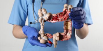 cáncer de colon en jóvenes