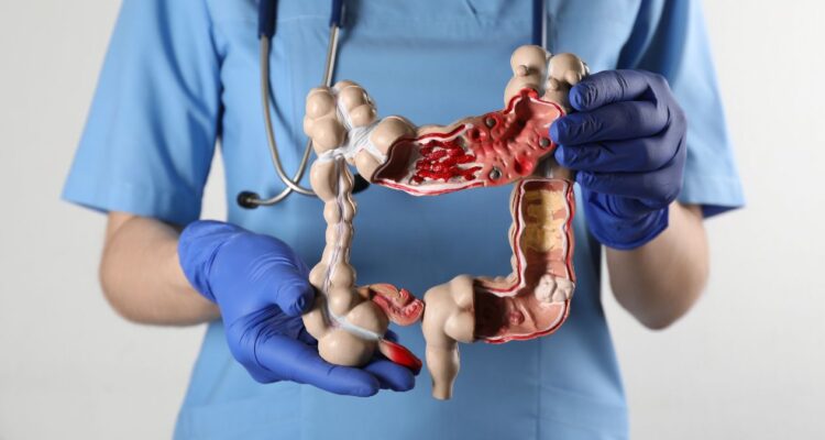 cáncer de colon en jóvenes