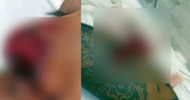 Hombre víctima de ataque de pitbull pide justicia por agresión en San Nicolás, NL