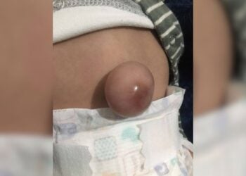 hernia umbilical Ciudad Victoria