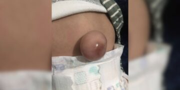 hernia umbilical Ciudad Victoria