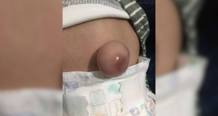 hernia umbilical Ciudad Victoria