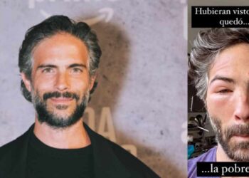 ¿Qué le pasó en el rostro al guapísimo actor Osvaldo Benavides