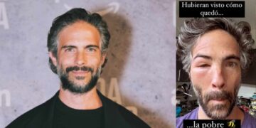 ¿Qué le pasó en el rostro al guapísimo actor Osvaldo Benavides