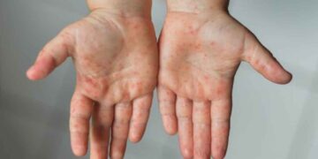 Alerta en EE.UU. por brote de sarampión dos muertes y más de 200 contagios