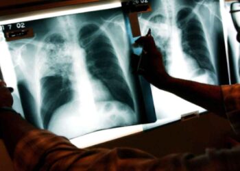 Nuevo León: Segundo estado con más casos de tuberculosis en 2025