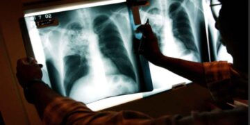 Nuevo León: Segundo estado con más casos de tuberculosis en 2025