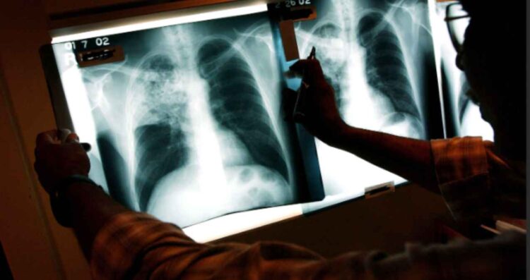 Nuevo León: Segundo estado con más casos de tuberculosis en 2025