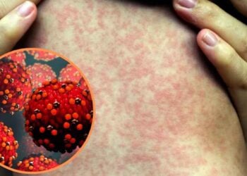 Salud emite alerta mundial por aumento de casos de sarampión