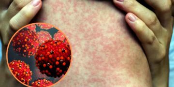 Salud emite alerta mundial por aumento de casos de sarampión