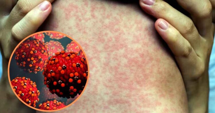 Salud emite alerta mundial por aumento de casos de sarampión
