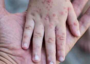 Tamaulipas refuerza vigilancia epidemiológica en la frontera ante brotes de sarampión