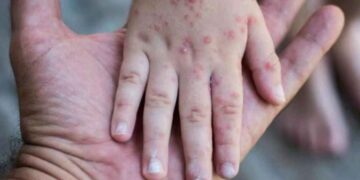 Tamaulipas refuerza vigilancia epidemiológica en la frontera ante brotes de sarampión