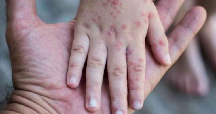Tamaulipas refuerza vigilancia epidemiológica en la frontera ante brotes de sarampión