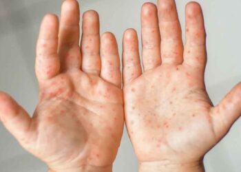 Casos de sarampión se duplican en México hay 126 contagios confirmados