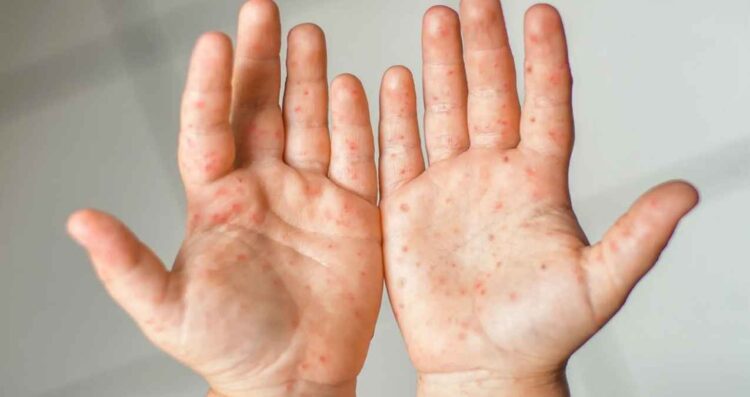 Casos de sarampión se duplican en México hay 126 contagios confirmados