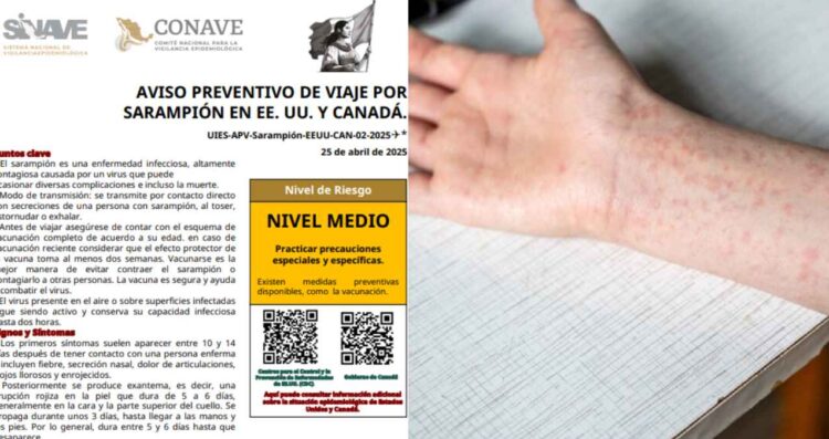 Secretaría de Salud emite alerta a viajeros por casos de sarampión en Estados Unidos y Canadá