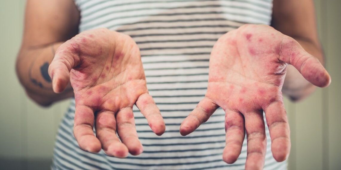 brote de sarampión en México