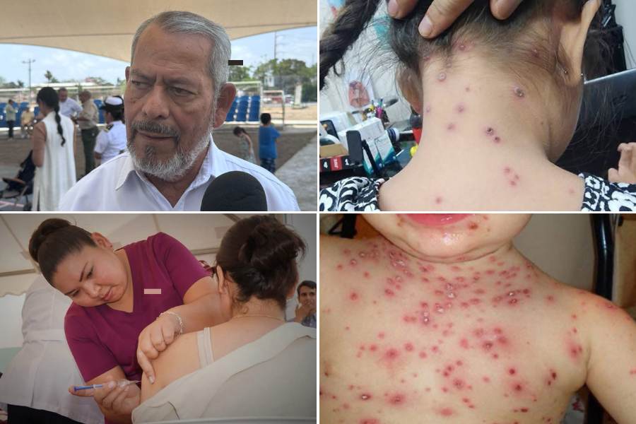 vacuna contra la varicela en México
