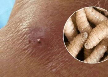 ¿Cuáles son los síntomas del gusano barrenador y existe vacuna contra la miasis?