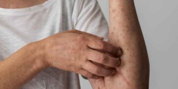 ¿Dónde hay sarampión en México Estos son los estados con casos confirmados