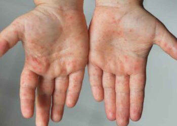Mueren dos niños menonitas por sarampión en Chihuahua; suman tres decesos en 2025