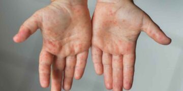 Mueren dos niños menonitas por sarampión en Chihuahua; suman tres decesos en 2025