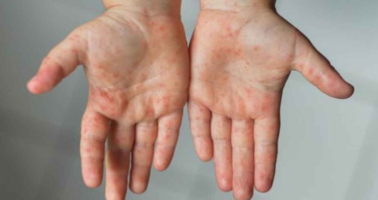 Mueren dos niños menonitas por sarampión en Chihuahua; suman tres decesos en 2025