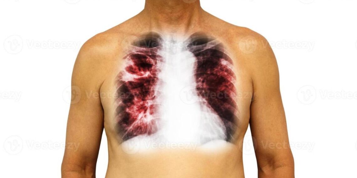 tuberculosis en Tamaulipas