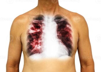 tuberculosis en Tamaulipas