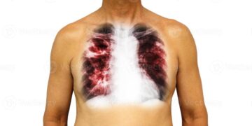 tuberculosis en Tamaulipas