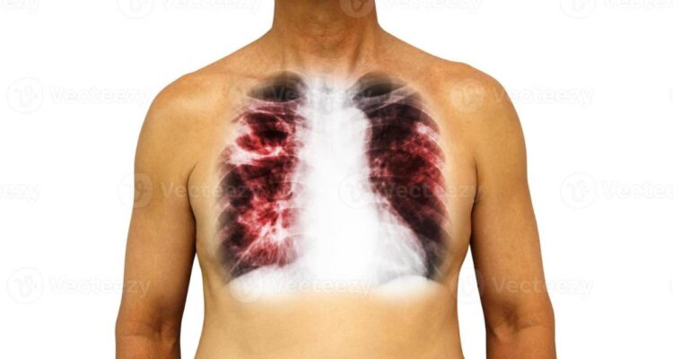 tuberculosis en Tamaulipas