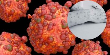 persona fallecida viruela del mono