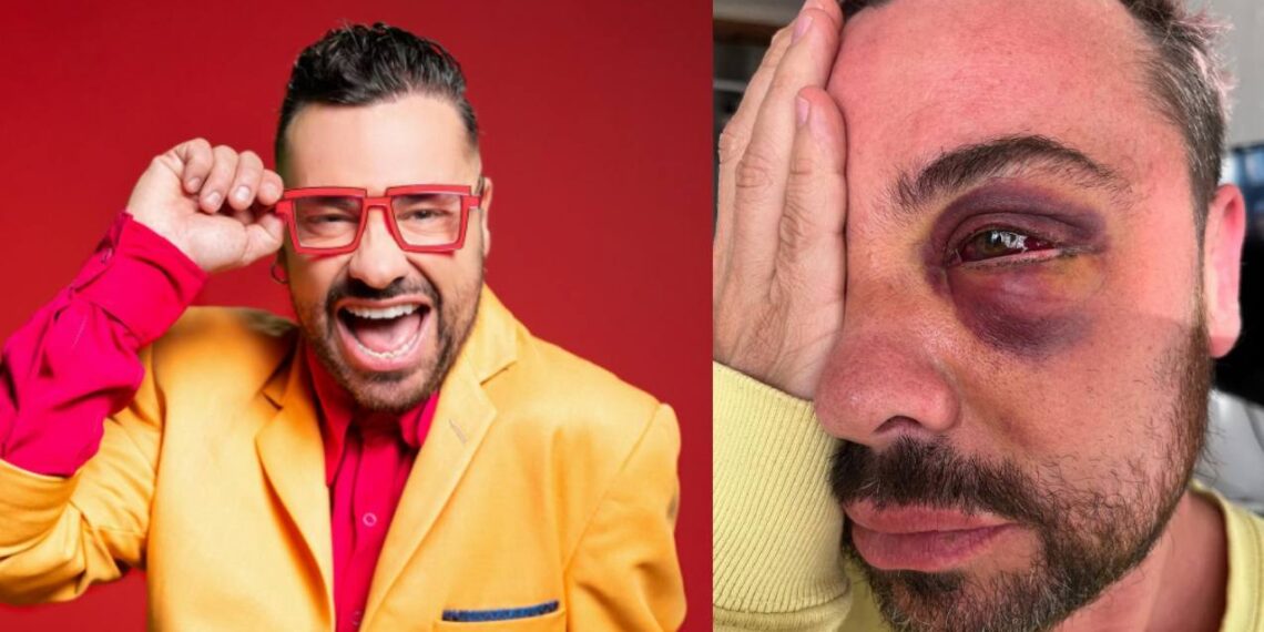 Shiky recuerda cómo perdió la vista de un ojo tras cirugía estética