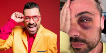 Shiky recuerda cómo perdió la vista de un ojo tras cirugía estética