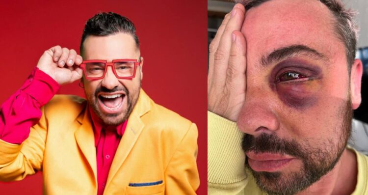 Shiky recuerda cómo perdió la vista de un ojo tras cirugía estética