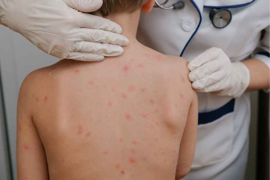 Brote de sarampión ya afecta a 25 estados; niños, los más vulnerables