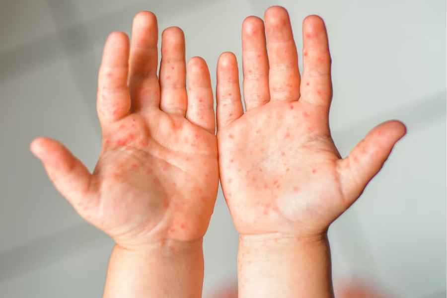 Tamaulipas refuerza prevención ante brote del virus Coxsackie en planteles básicos