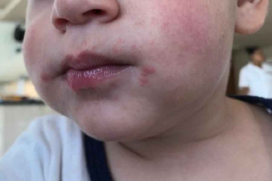 Tamaulipas refuerza vigilancia por aumento de contagios de “Boca, Manos y Pies”