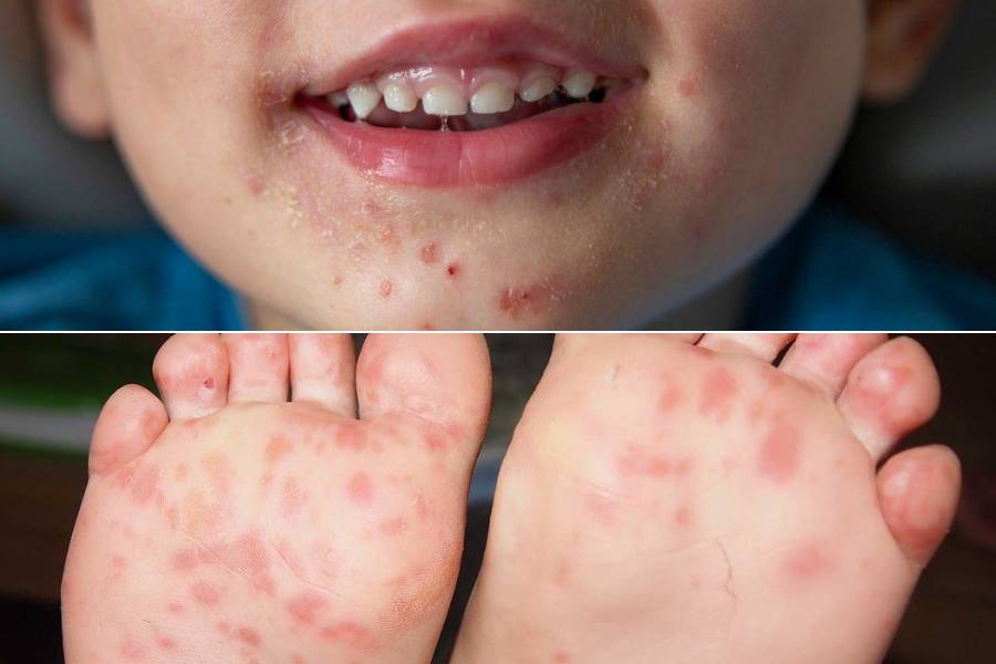 virus coxsackie en escuelas de tampico