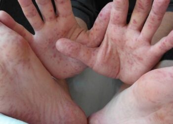 virus coxsackie en Tamaulipas
