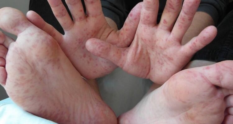 virus coxsackie en Tamaulipas