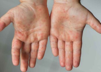 ¿Qué es el virus Coxsackie Así se está propagando la enfermedad de manos, pies y boca en México