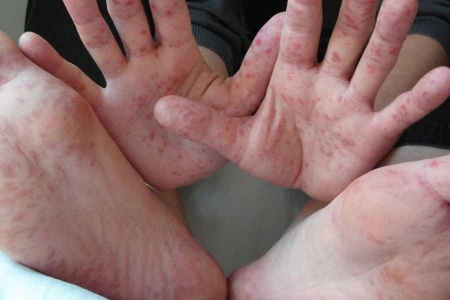 ¿Qué es el virus Coxsackie Así se está propagando la enfermedad de manos, pies y boca en México