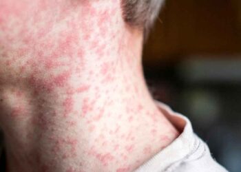 México registra 78 nuevos casos de sarampión: Ssa