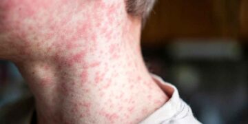 México registra 78 nuevos casos de sarampión: Ssa