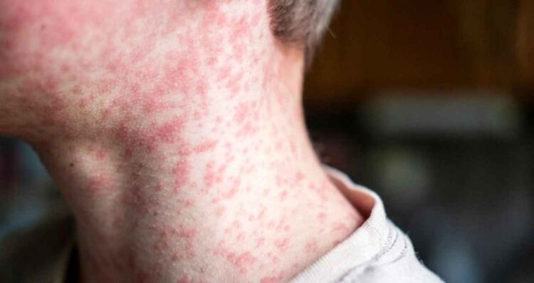 México registra 78 nuevos casos de sarampión: Ssa