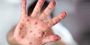 OPS advierte que persiste el brote de sarampión en México