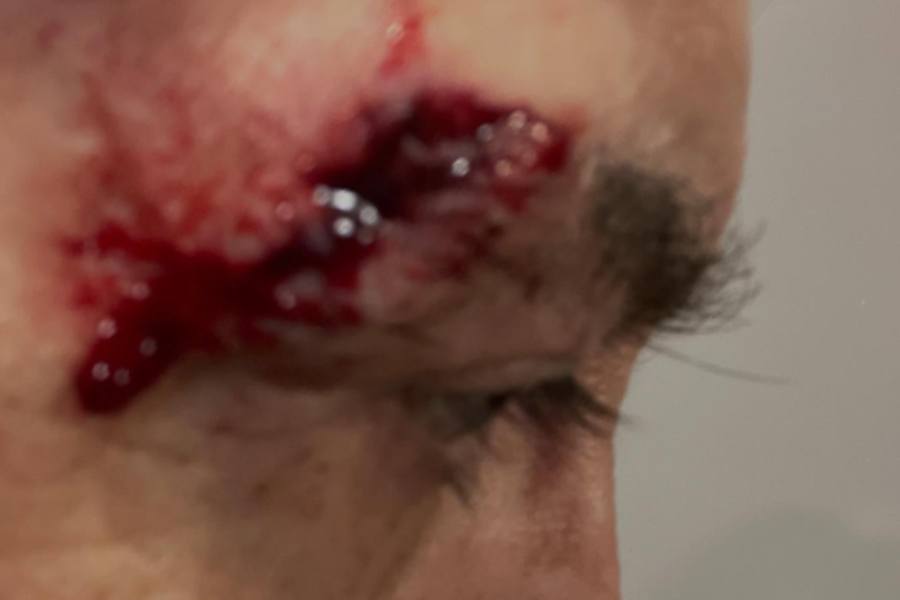 Pepillo Origel vuelve a redes luego de la caída que le provocó una lesión en la cara